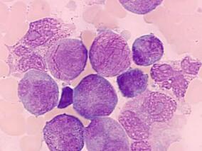 非M3 AML：FLAI-5/Ara-C+Ida诱导后风险导向的巩固疗法的安全性有效性