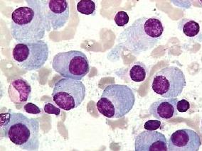 多发性骨髓瘤患者来那度胺联合地米常见3、4级中性粒细胞减少症