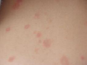 男19岁，消瘦1个月，多饮10天，腹痛、呕吐5天，加重16小时