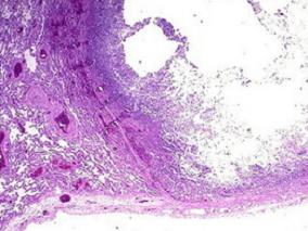 女64岁,发热,咳嗽9天,伴声嘶,气促3天
