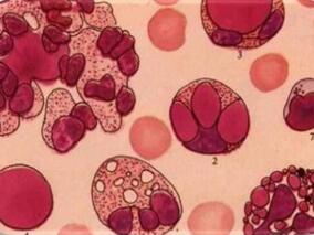 贝利单抗可以节约SLE患者的类固醇剂量