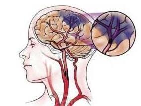 吡拉西坦能否改善脑卒中后患者的语言能力？