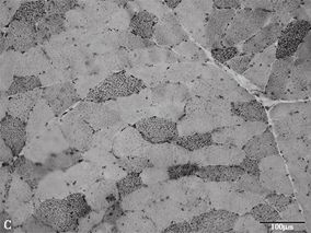 男64岁,活动后四肢疲劳力弱2年门诊就诊