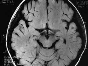 少年男性行走不稳 患有何种怪病?