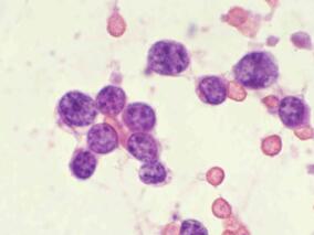 R-CHOP输注方案对原发性纵隔B细胞淋巴瘤疗效佳
