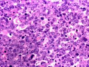 年轻高风险弥漫性大B细胞淋巴瘤患者：强化化疗或是最佳选择