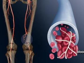 那曲肝素减用于急性症状性小腿深静脉血栓患者有百害而无一利？