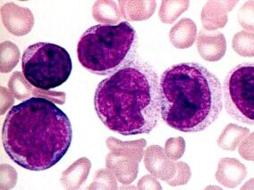 多学科讨论：尼洛替尼用于慢粒慢性期的一线治疗安全有效