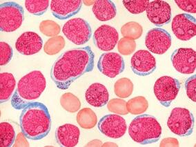 迷你MEC方案治疗复发或难治急性白血病是否安全有效？