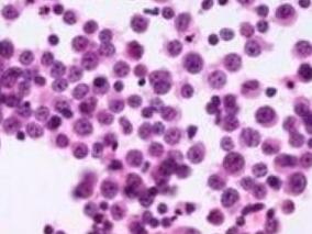 周身骨痛、低磷血症5年，血小板减少1年，行走受限，是关节病吗?