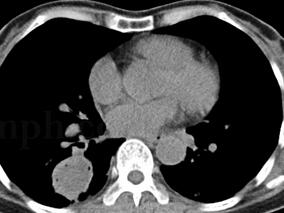 反复咳嗽、咳痰、咯血28年,反复对症治疗效果不佳,何病?