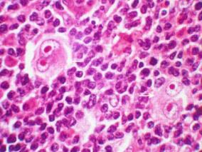 DLBCL和霍奇金淋巴瘤的最佳挽救疗法方案是GDP?