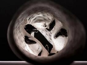 生物瓣膜植入后添加VKA对血栓栓塞或死亡率或无益