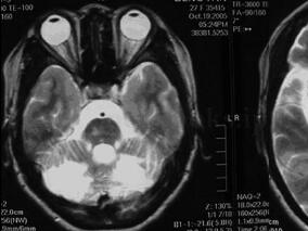 青年女性,反复发生脑梗死症状,您能侦破她患有何病吗?