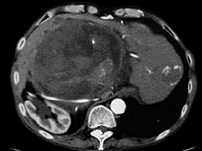 腹部肿物18年,曾手术失败,如何医治?