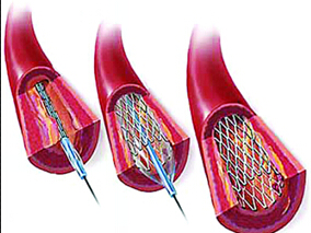 糖尿病患者PCI后长期双抗血小板治疗会是得不偿失吗?