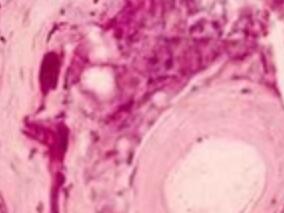 成人念珠菌病:棘白菌素vs氟康唑