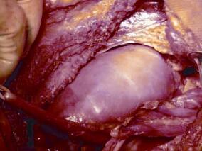 先天性巨输尿管症合并重复肾重复输尿管畸形1例