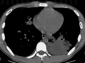 CAP诊断明确治疗却一波三折 这些“套路”你遇到过吗?