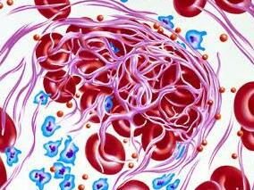 一个简单的预测模型可帮医生识别出抗凝较差的患者