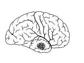 低分级胶质瘤高风险患者:替莫唑胺化疗还是放疗?