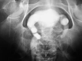 排尿困难伴双肾积水6年余 缘何诊治歧义？