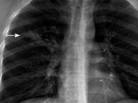 头痛难以忍受,误诊为病毒性脑膜炎,竟是肺炎支原体肺炎!