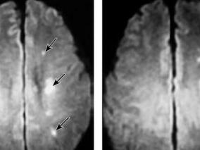 颅脑DWI异常的短暂性脑缺血发作进展为缺血性卒中经典病例