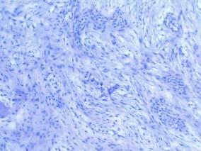 胫骨造釉细胞瘤切除 重建方法如何抉择？