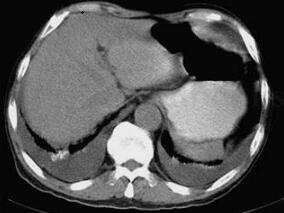这种肝炎在普通病房极罕见 您了解吗?
