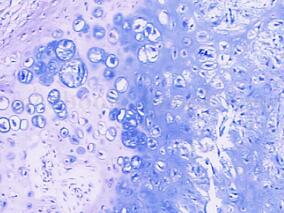 左髋臼软骨肉瘤局部切除马鞍式人工关节置换术