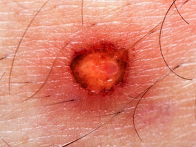 付小兵院士:创伤性溃疡创面治疗方案分析