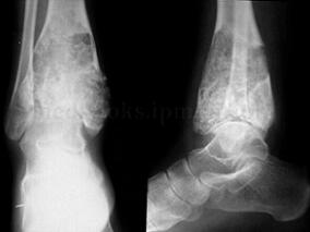 胫骨下端软骨肉瘤切除后大段异体骨重建 如何选择替代物？