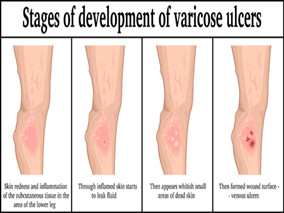 曹烨民主任:下肢静脉性溃疡创面临床治疗探讨