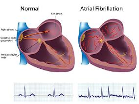 非瓣膜性房颤患者：利伐沙班vs阿哌沙班