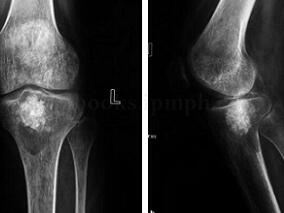 骨病灶刮除和纠正局部畸形孰轻孰重？