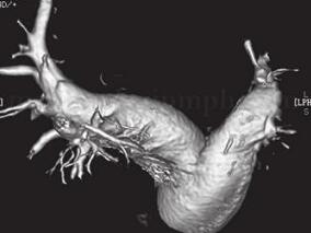 6岁患儿肺动脉高压的原因是……