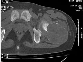 误诊为“骨巨细胞瘤” 实则……
