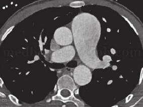 一种少见先天性肺血管畸形病