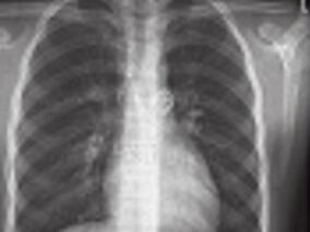 先心病中较常见的外周血管病变一例