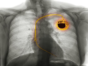 频发室性期前收缩患者除了用药还能怎么治？