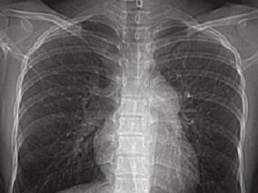 如何区分特发性肺动脉高压?