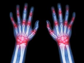 非布司他治疗早期痛风效果如何?