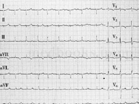 SLE也能引起肺动脉高压?