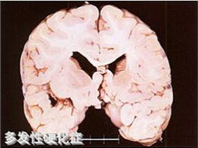 雌孕激素联合INF-β是否能改善MS女性的认知功能？