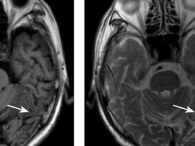 对失读症患者阅读功能的随访 发现其康复阶段的3个特点