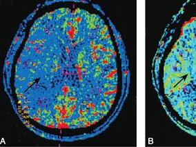 大脑中动脉慢性闭塞血管再通治疗经典案例1例