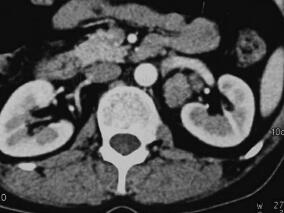 面部变红2年，痤疮并血压高1年，皮肤变薄，更年期综合征？