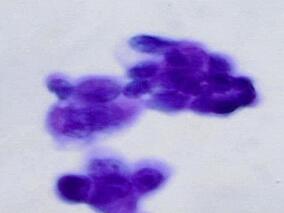 肺内影像实变影,抗生素治疗无效,激素治疗部分病灶消散后病情加重,何病?