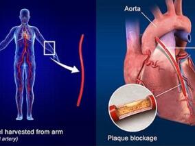 既往冠脉搭桥的ACS患者添加依折麦布至他汀能否增加获益?